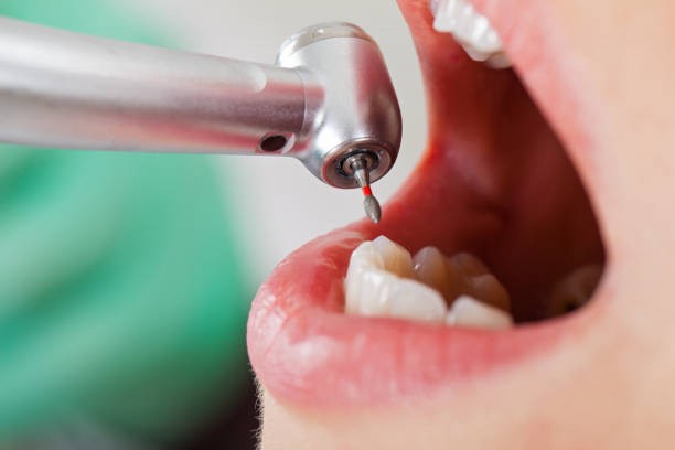 Best Emergency Wisdom Teeth Removal in Caledonia, WI
